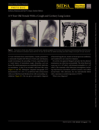 A 9-Year-Old Female With a Cough and Cavitary Lung Lesion thumbnail